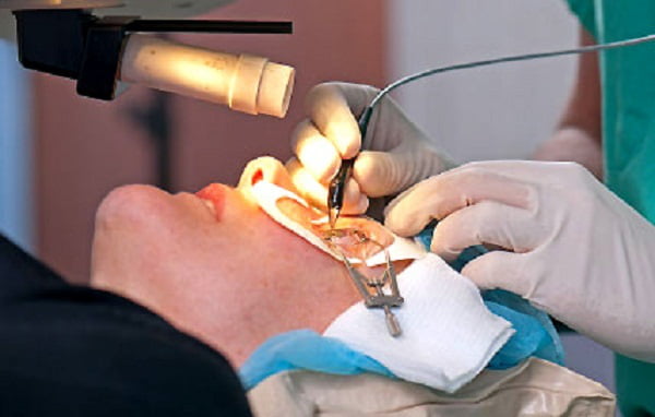 Có được thanh toán BHYT khi đi mổ cận thị?.